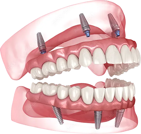 3D-Darstellung eines All-on-4-Konzepts